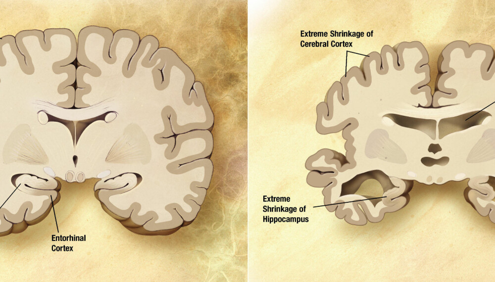 ALZHEIMER: Sammenligning av en normalt aldret hjerne (venstre) og hjernen hos en pasient med Alzheimers sykdom (høyre). Forskjellene er markert. ALZHEIMER: Sammenligning av en normalt aldret hjerne (venstre) og hjernen hos en pasient med Alzheimers sykdom (høyre). Forskjellene er markert.