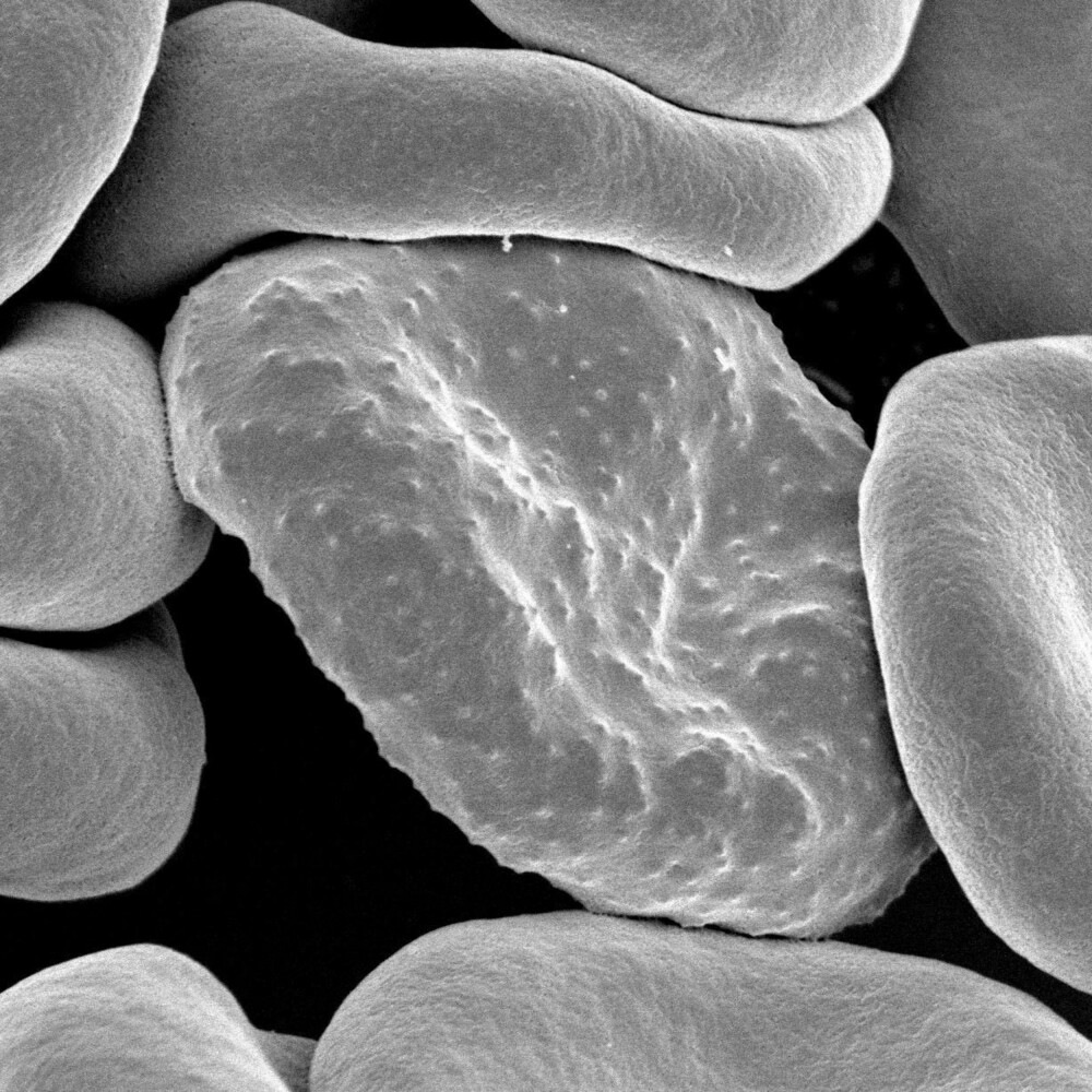 ANGREPET: Rød blodcelle infisert av malaria. ANGREPET: Rød blodcelle infisert av malaria.