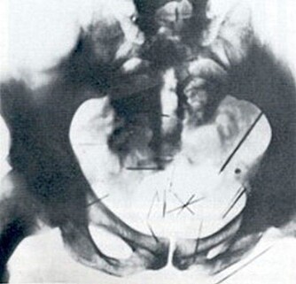 NØT SMERTE: Albert Fish stakk nåler inn i sin egen kropp. Her ved kjønnsorganene. NØT SMERTE: Albert Fish stakk nåler inn i sin egen kropp. Her ved kjønnsorganene.