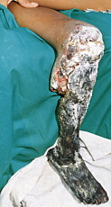 NEKROSE: Her vises et to uker gammelt slangebitt av lanseslangen bothrops asper, som er nært beslektet med bothrops insularis. Sistnevnte har imidlertid en gift som er tre til fem ganger sterkere... NEKROSE: Her vises et to uker gammelt slangebitt av lanseslangen bothrops asper, som er nært beslektet med bothrops insularis. Sistnevnte har imidlertid en gift som er tre til fem ganger sterkere...